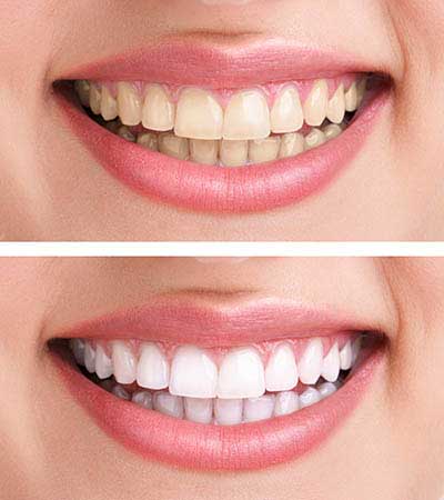 Cosmetic Dentistry at One Stop Implants