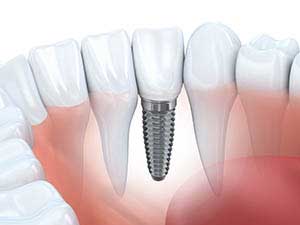 One Stop Implants Dental implant picture