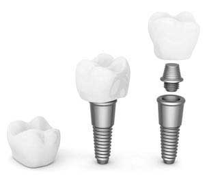 Dental Implant Abutment, Crown, and Implant